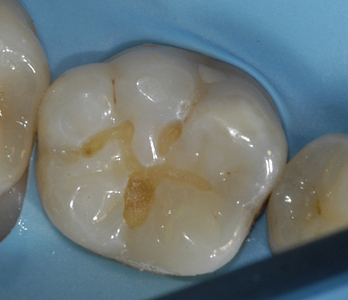 Fissurotomy preparation where heated low viscosity paste resin outperforms flowables. 