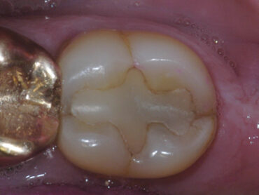Why We Need a Resin QR Code When Choosing a Resin for Longevity and ...