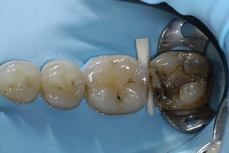  Stained dentin requiring masking with an opaque resin. 