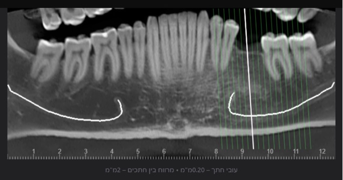  Automatic measurement of the height and width of the alveolar ridge at the designated implantation site (Diagnocat, Diagnocat Inc., USA).