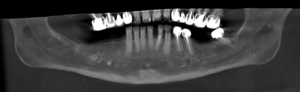 A panoramic reformatting performed by AI based on the patient’s CBCT scan. The lesion on the right side of the jaw was marked by the artificial intelligence and alerted the dentist.