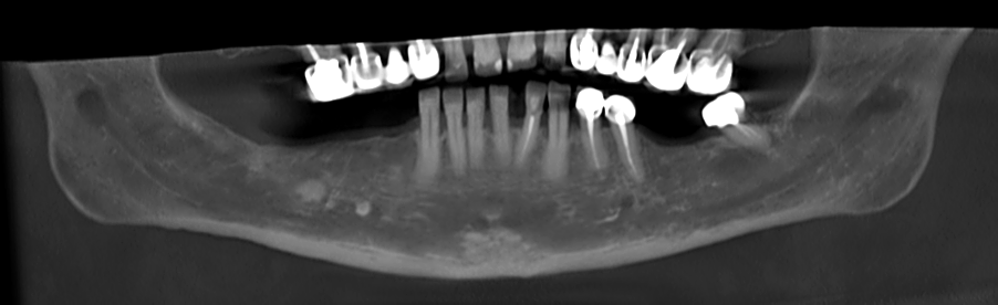  A panoramic reformatting performed by AI based on the patient’s CBCT scan. The lesion on the right side of the jaw was marked by the artificial intelligence and alerted the dentist.  