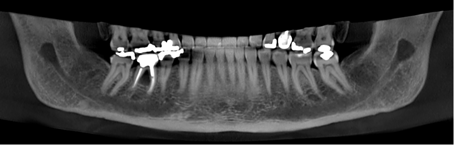  Panoramic reformatting performed by artificial intelligence (Diagnocat, Diagnocat Inc., USA). A hypodense lesion is clearly seen in the furcation region of tooth 46. 