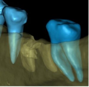 Virtual extraction of tooth 46 (before the actual procedure) allows for a good appraisal of the damage caused by the furcational lesion and planning of the socket preservation / implant placement procedures that would follow the extraction.