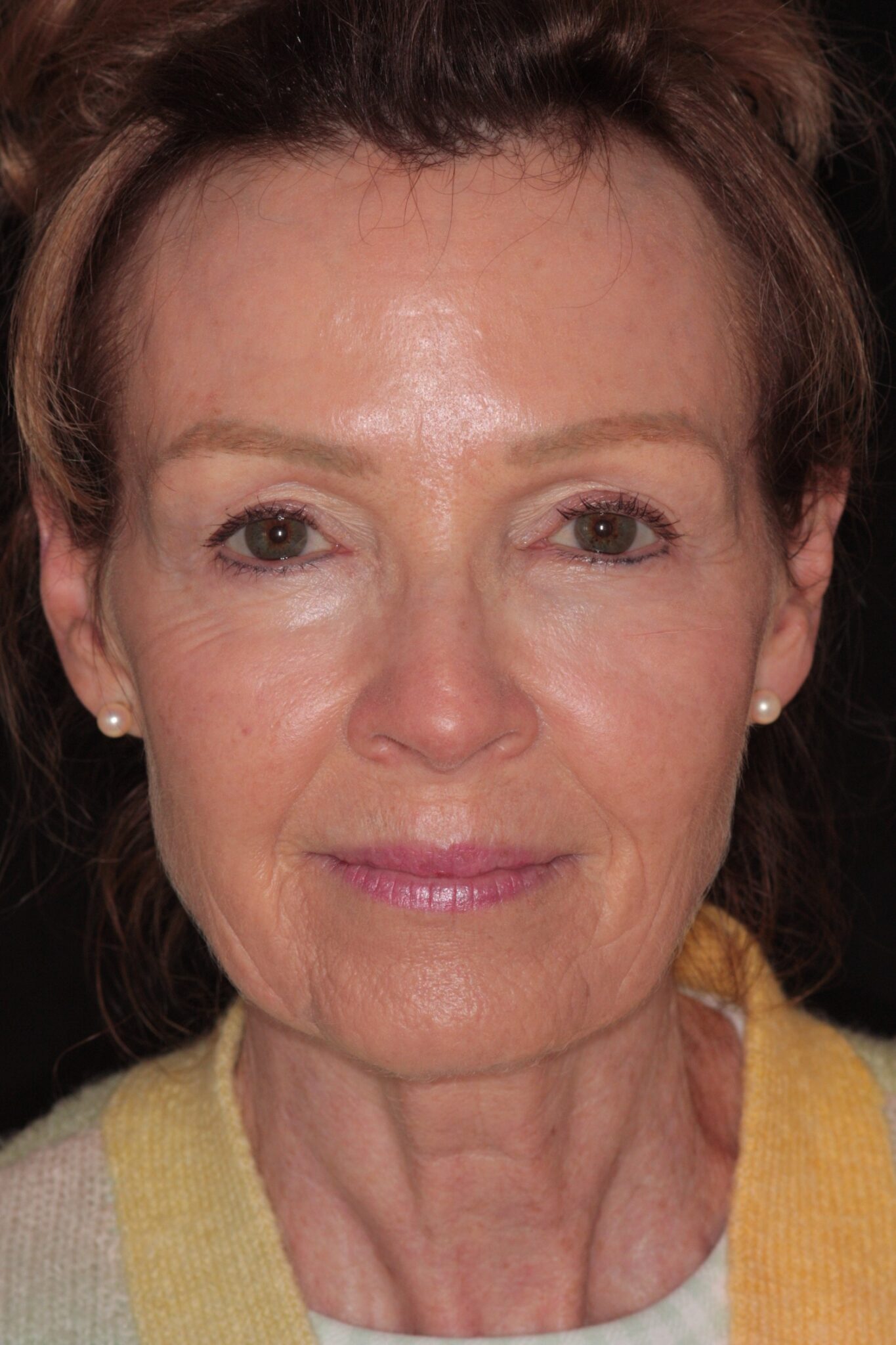 Fig 14. lines softened 2 weeks after treatment Oral Health Group