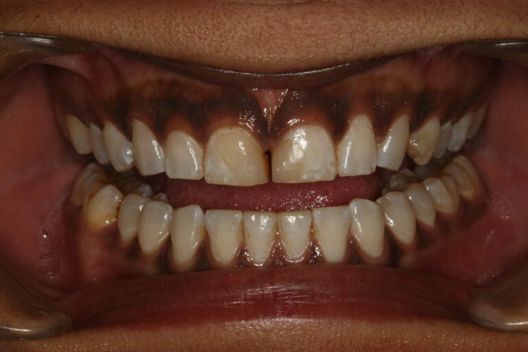 Preoperative retracted view showing diastema, improper proportions, and improper width-to-length ratios.  