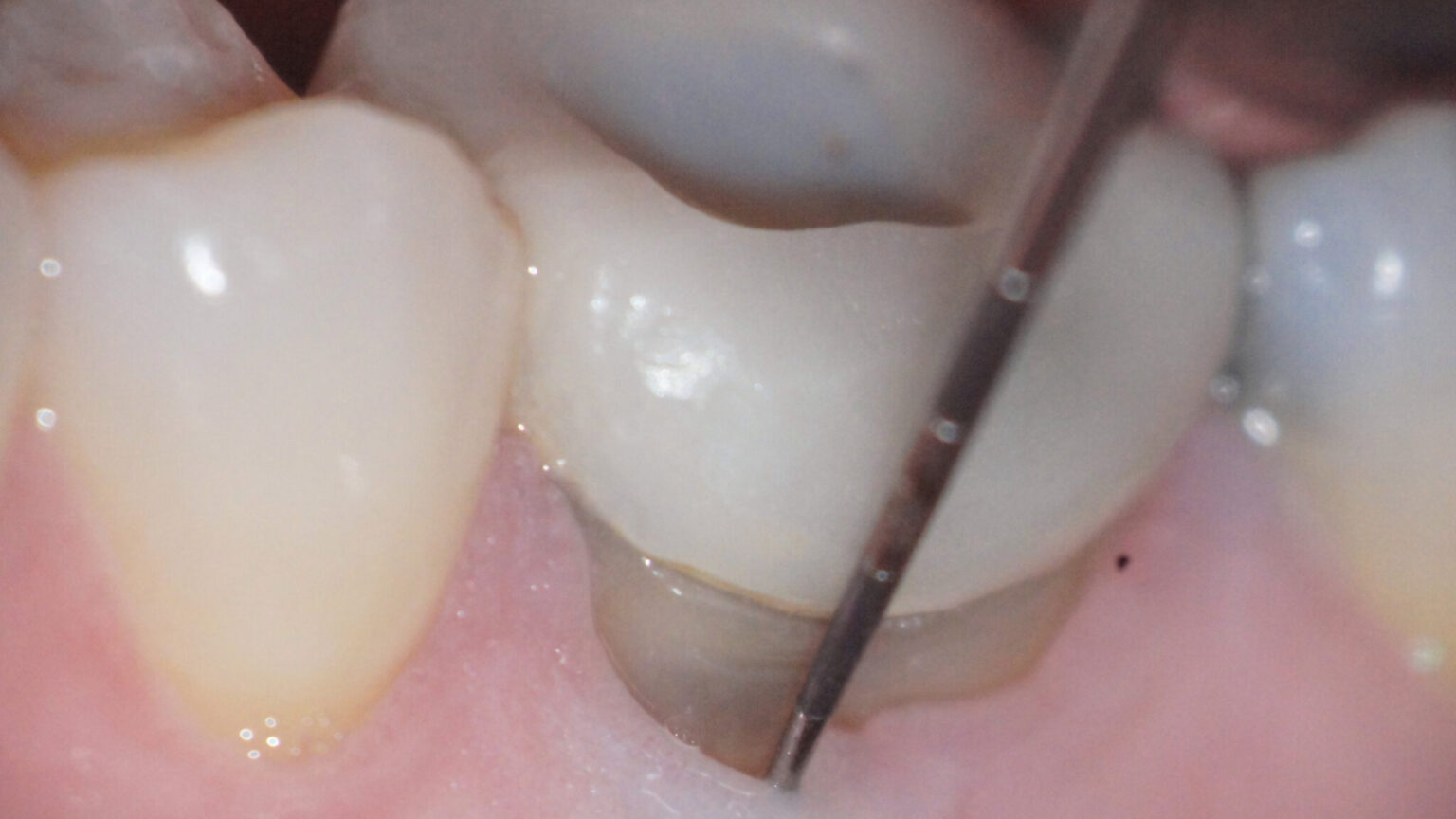 Endodontic Predictability “What Matters?* Oral Health Group