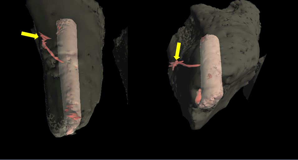 A toothatlas.com example of actual teeth with lateral canals emanating from lateral canals (arrows). 