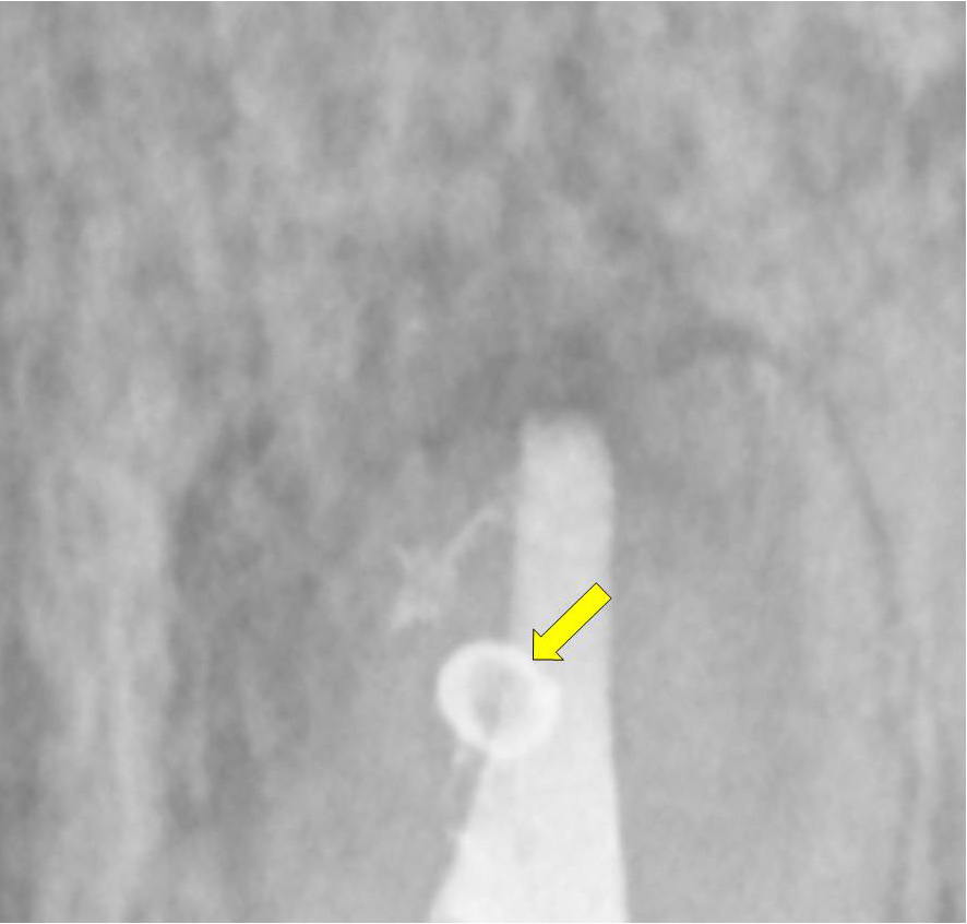 Magnified image of apical obturation showing similar apical foraminal POE branching with one lateral canal surplus sealer pressed against the facial of the root’s apical dome (See circle).  