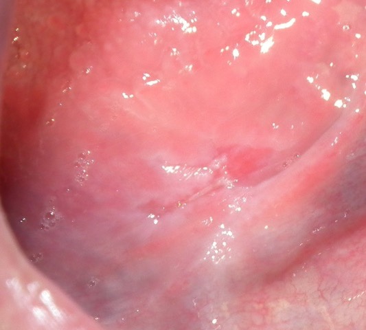 Initial Presentation
Biopsy: “ulceration and inflammation“.