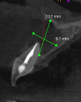 Extensive bone loss is apparent around the apex of #8. CBCT revealed an absence of the buccal plate with a thin palatal plate. 