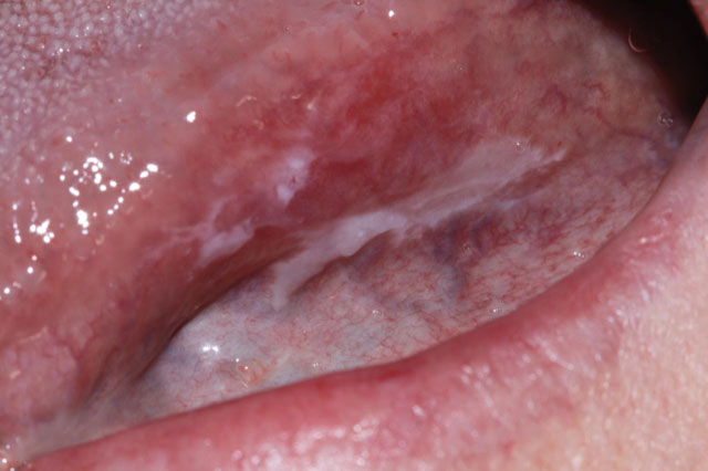 Lichenoid Mucositis and Mild Dysplasia