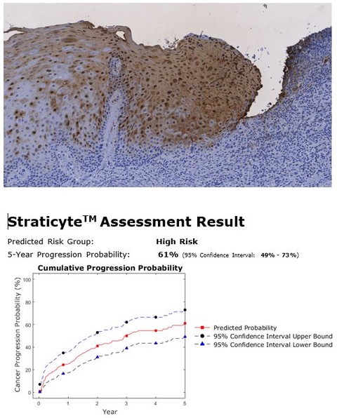 Hyperkeratosis and mild dysplasia 61% Oral Cancer risk.