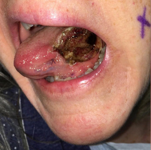 Immediately after partial glossectomy.