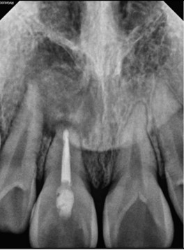 At the 1-year recall appointment, the surgical site is evaluated radiographically both 2D