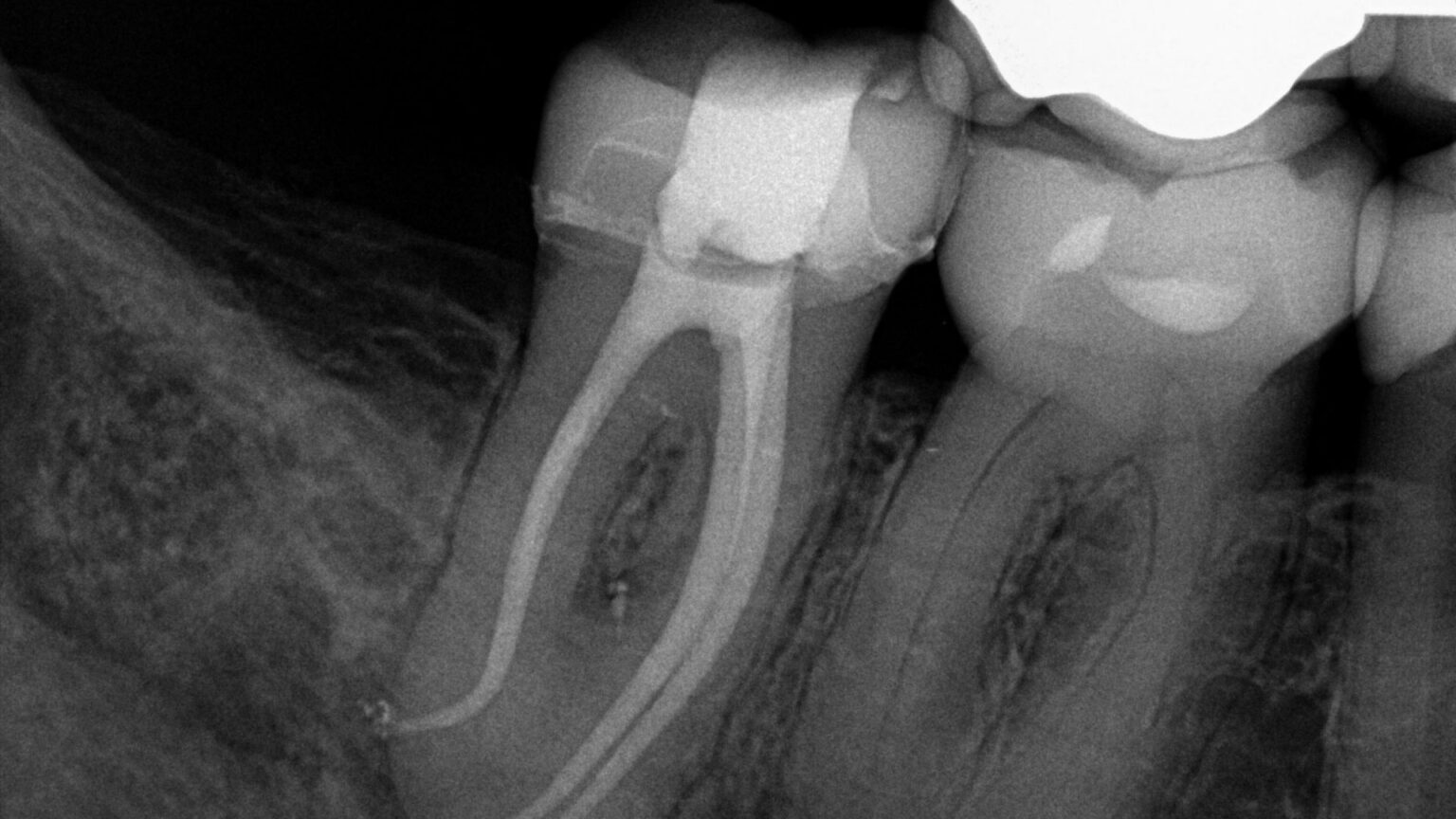 Minimally Invasive Endodontics with Laser Activated Irrigation