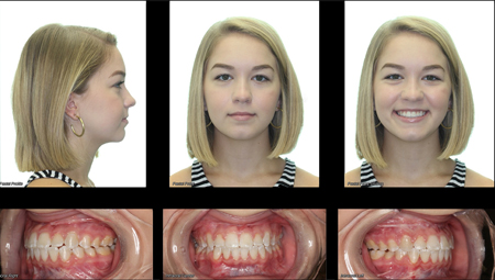  Lefort 1 advancement of the maxilla resulting in an improved occlusion, profile, and esthetics.