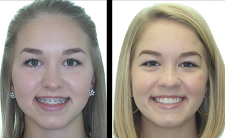  Lefort 1 advancement of the maxilla resulting in an improved occlusion, profile, and esthetics.