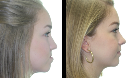  Lefort 1 advancement of the maxilla resulting in an improved occlusion, profile, and esthetics.