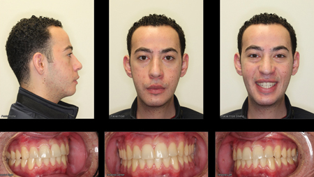 BSSO advancement of the mandible resulting in an improved profile, esthetics, and airway