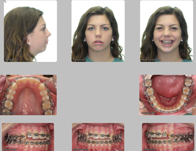 Combination surgery involving both the upper and lower jaws, dramatically improving her occlusion, function, and smile.