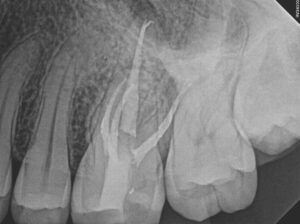 Completion Periapical Radiograph.