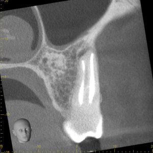  Coronal View of MB root anatomy, 18 months after initiation of therapy.