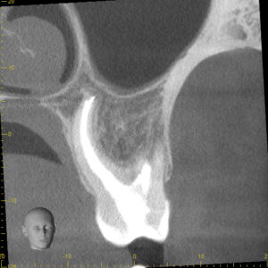 Coronal View of Palatal root anatomy, 18 months
after initiation of treatment. 