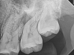 . Pre-
Operative Periapical Radiograph