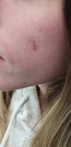 Cutaneous healing at CaOH follow-up.