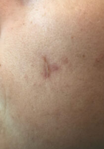Close up at completion of endodontic therapy.