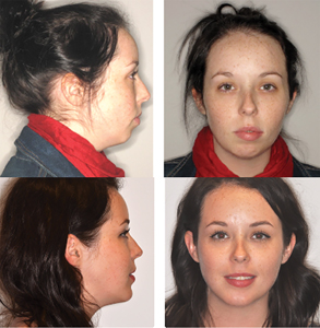 The preoperative and one year postoperative facial frontal and profile images of an orthognathic patient who underwent a Le Fort advancement and impaction with cant correction, a bilateral sagittal split osteotomy asymmetric advancement and genioplasty advancement.