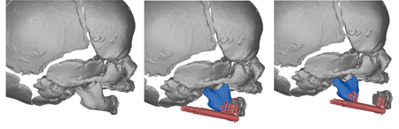  Device Selection, Osteotomy site selection, evaluation of vectors, and Virtual Surgical Planning 3D Modeling Systems. 
A. Left: Pre-Operative anatomy. Middle: Initial Position, activated 0.5mm. Right: Final position, activated 15mm