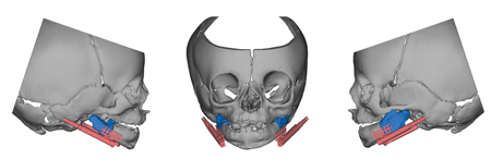 . B. Right sagittal, coronal, and left sagittal views of internal appliance.