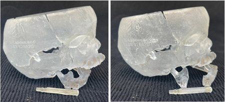 B. Left: 3D model of initial placement of internal appliance. Right: Final position.