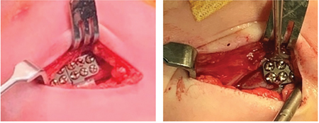 B. Left: Placement of the appliance. Right: Removal of the appliance