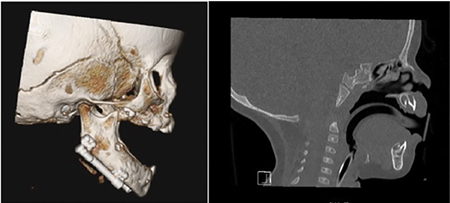 D: Post-operative CT scan taken at time of appliance removal.