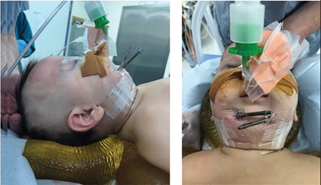 Surgical Management with Distraction Osteogenesis for a hypoplastic mandible in an 8-week-old male. 
A. Left: Pre-operative photo. Right: Post-operative photo. 
