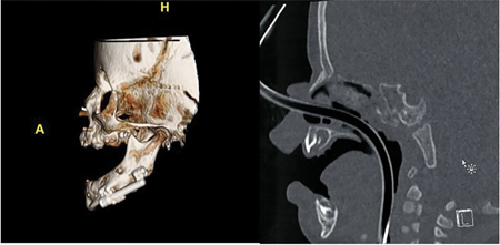 D. Post-operative CT scan taken at time of appliance removal.