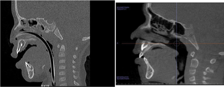 B. Left: Intra-Operative CT scan. Right: Post-Operative CT scan.