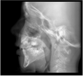 C) Post-operative Lateral Cephalogram.