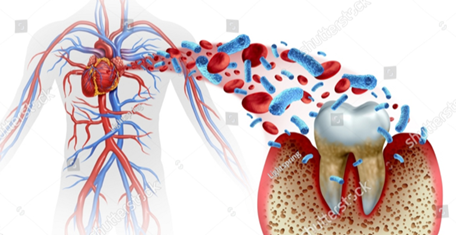 Gum Disease starts BETWEEN the teeth. It is also the point of entry of bacteria into the blood stream contributing to heart and systemic disease