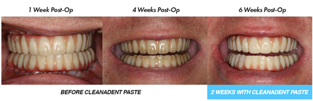 Before and after picture using Cleanadent Paste and Dr. B Toothbrush.