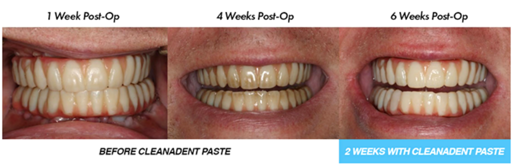  Before and after picture using Cleanadent Paste and Dr. B Toothbrush.