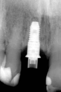 X-ray after placement of the immediately loaded prosthesis.