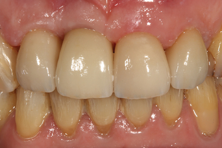  Image after placement of the final crown and ceramic veneers on the adjacent teeth. 