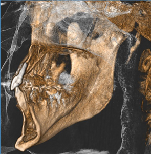  Control cone beam five years after treatment. As can be seen, the bone margin remains stable.