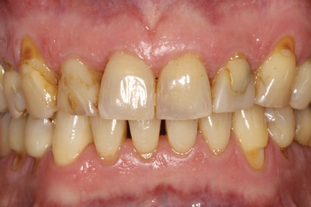 The initial and final image of the case where we can see the initial appearance of the aesthetic front and that achieved with the rehabilitation after five years of follow-up.