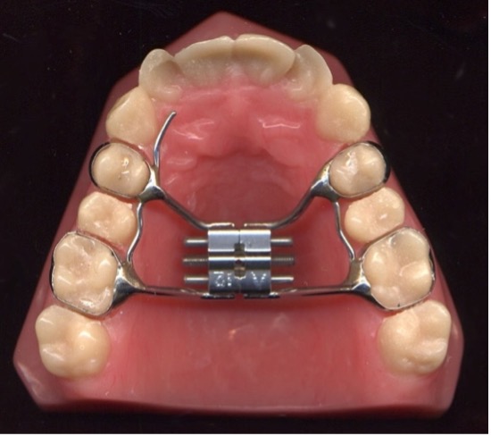 Example of a tooth-borne expansion appliance: Hyrax.