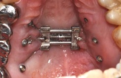  Example of a mini-screw retained RPE appliance: MARPE.
